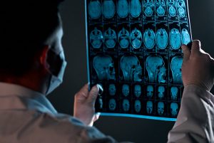 Brain Injuries